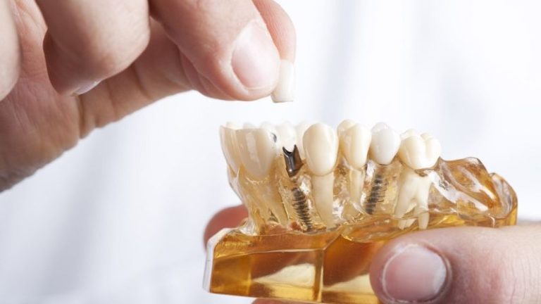 رابطه ایمپلنت دندانی و دیابت چیست ؟